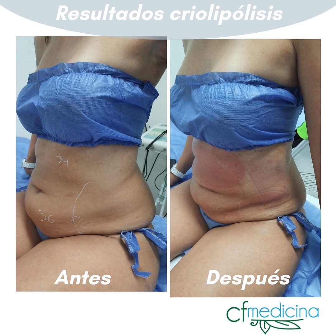 Criolipolisis – Cfmedicina