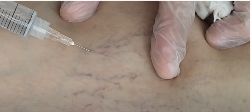 tratamiento arañitas